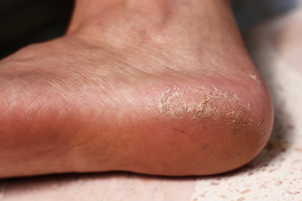 Calluses Commack, NY