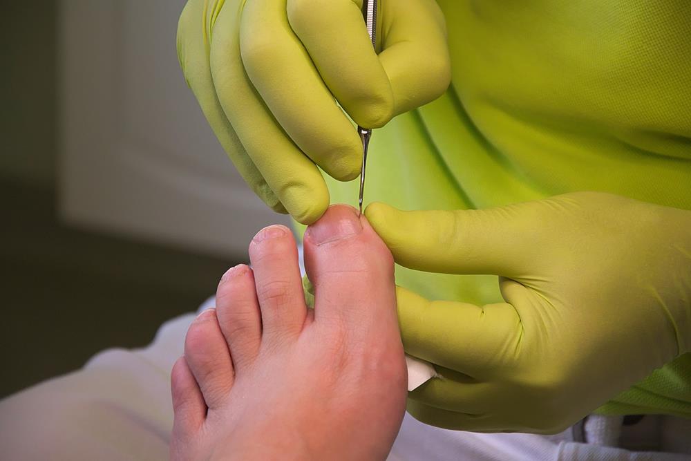 Ingrown Toenails Commack, NY